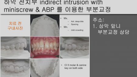 [Case Review][#12] 하악 전치부 indirect intrusion with miniscrew & ABP 를 이용한 부분교정